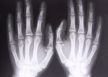 Когда назначают рентген руки?