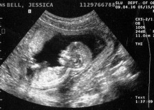 Точное определение здоровья малыша по фото УЗИ на 13 неделе беременности