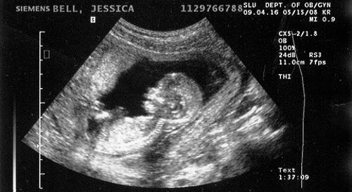 Снимок на 13 неделе беременности