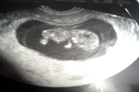Информация о развитии эмбриона на скрининге 12-й недели