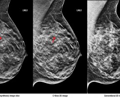 Подробнее о маммографии молочных желез