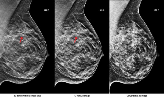 Снимки с маммографии