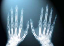 Безопасно ли часто делать рентген?