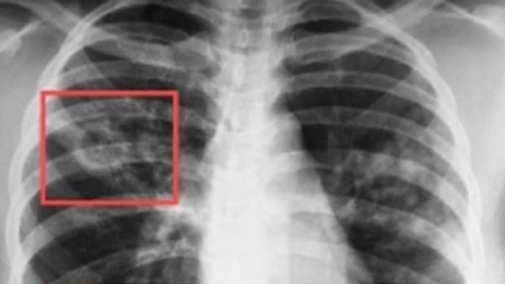 Туберкулез на флюорографическом снимке
