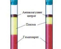 Причины развития анемии по показателю HCT в анализе крови