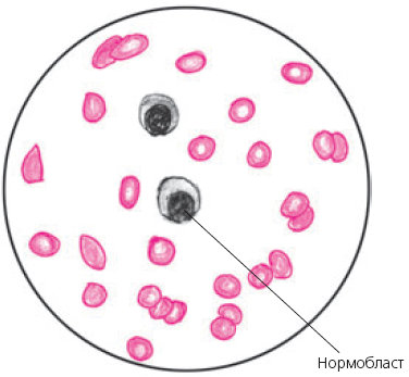 Нормобласты в крови картинки