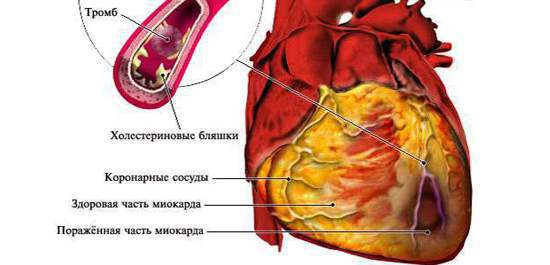 Что представляет собой инфаркт миокарда?