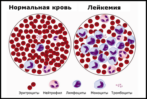 Пропорции крови при лейкемии