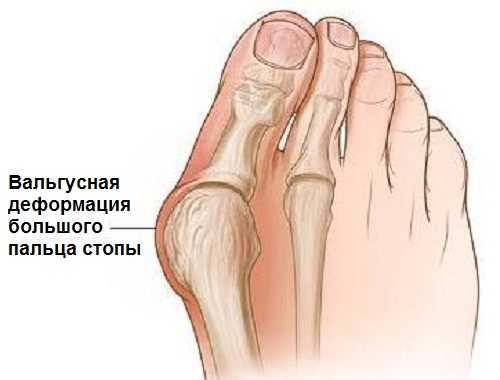 Вальгусная деформация пальца стопы