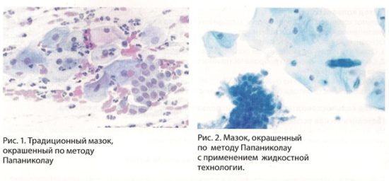 Адекватность цитологического образца адекватный