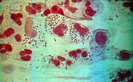 Коккобациллярная флора в мазке у женщин картинки