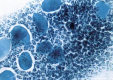 Повышение лейкоцитов в мазке на микрофлору
