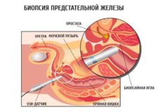Проведение процедуры биопсии предстательной железы
