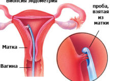 Как проводится процедура аспирационной биопсии эндометрия?