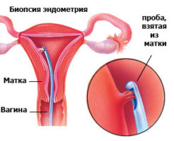 Как проводится процедура аспирационной биопсии эндометрия?