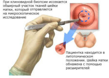 Процедура биопсии шейки матки