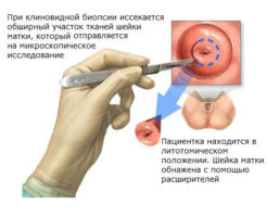 Процедура биопсии шейки матки