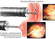 Эндоскопическая биопсия желудка