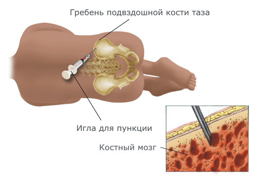 Пункция из кости таза