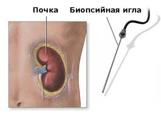 Процедура биопсии
