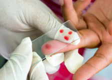 Какая должна быть норма тромбоцитов в крови у женщин?