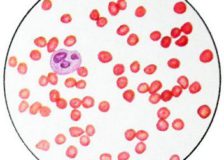 Патологическое изменение кровяных телец — анизоцитоз эритроцитов