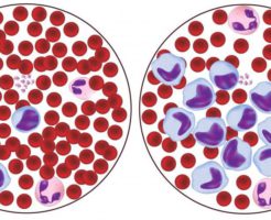 Факторы, из-за которых лимфоциты повышены в крови