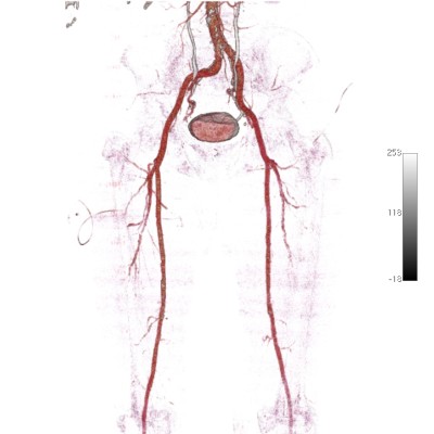 Ангиография артерий нижних конечностей фото