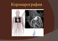 Коронарная ангиография – эффективная диагностика болезней сердца