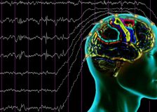 Диффузные изменения биоэлектрической активности мозга на ЭЭГ